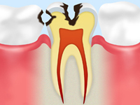 C2【象牙質の虫歯】