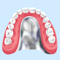 金属床義歯