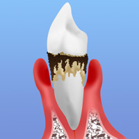 妊娠中の歯周病には要注意